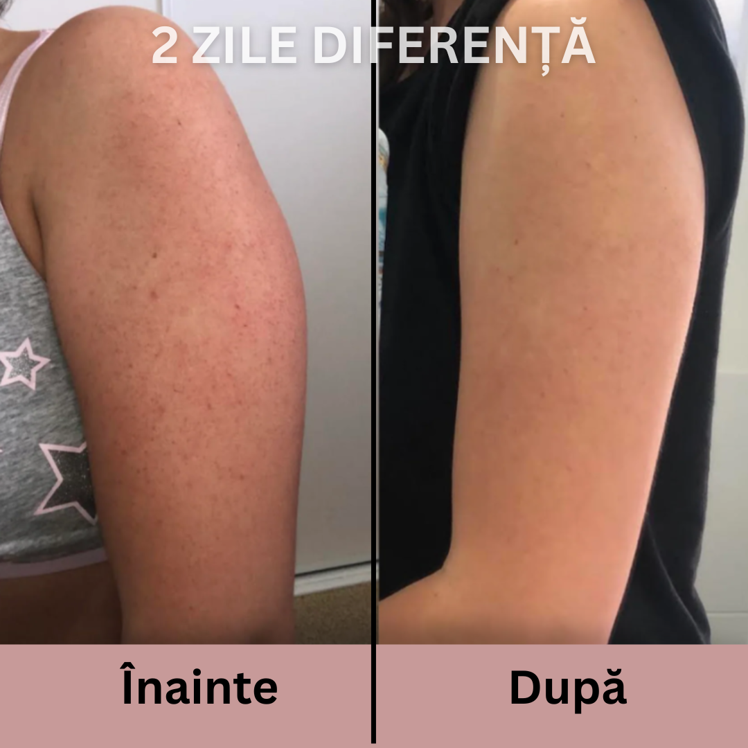 Exfoliant Avansat pentru Piele Aspră și Keratoză Pilară