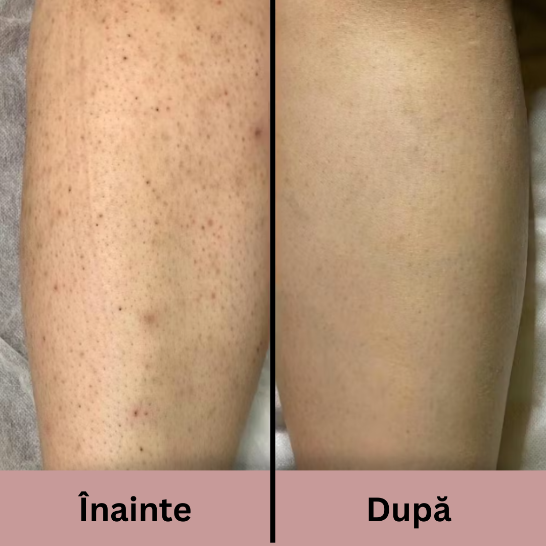 Exfoliant Avansat pentru Piele Aspră și Keratoză Pilară