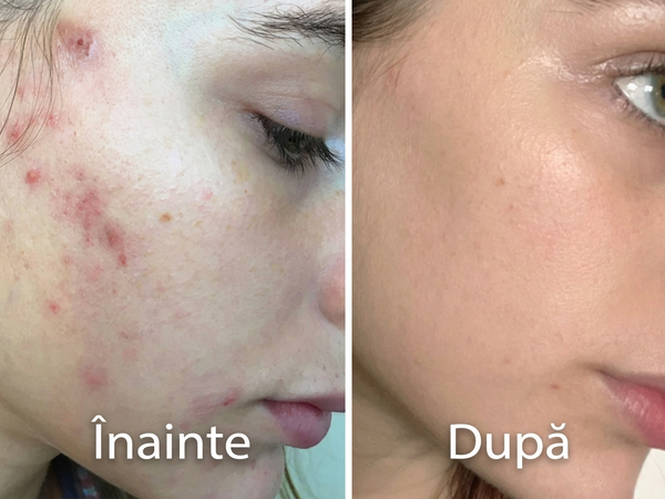 Mască LED Profesională pentru Rejuvenare Facială